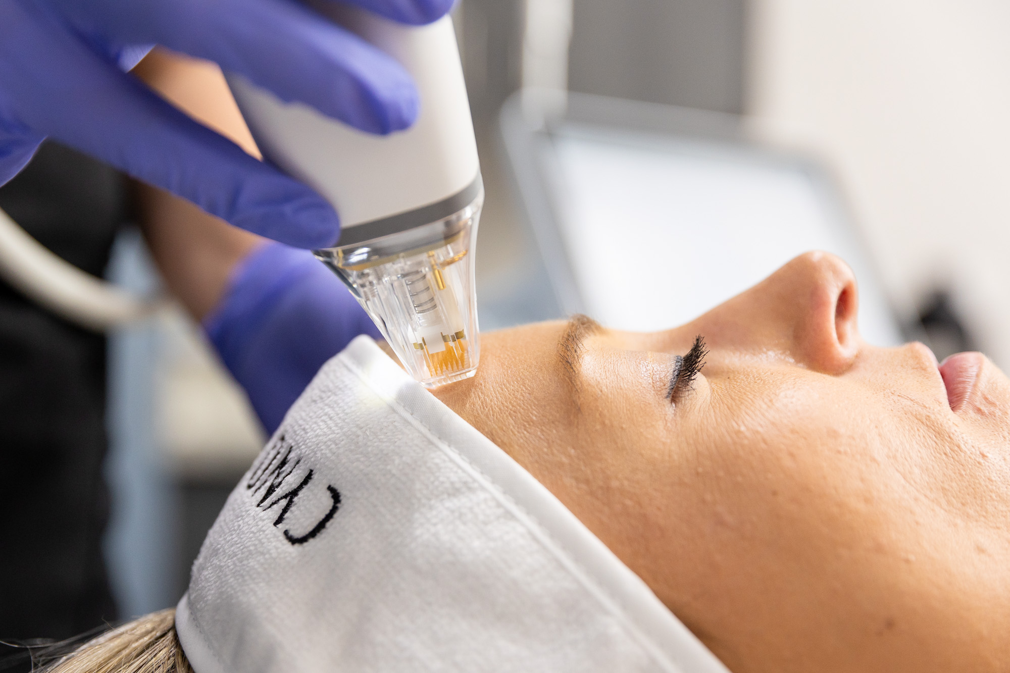A patient relaxes on her back as she undergoes her microneedling in Arlington treatment. Her provider, wearing surgical gloves, gently glides the hand-held microneedling device over the patient's forehead to improve skin laxity and fine lines.