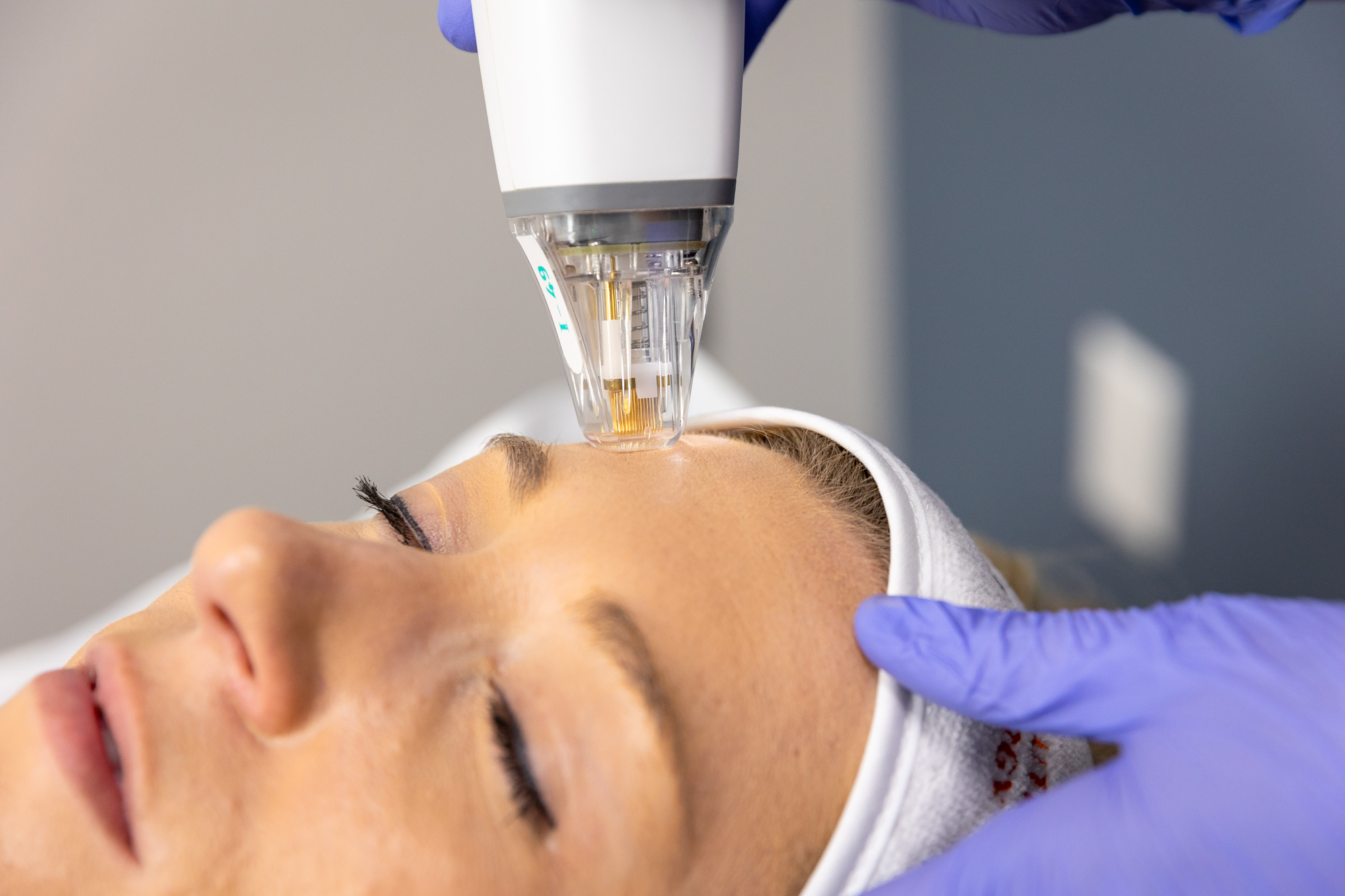 A patient enjoys RF microneedling for her skin tightening in Arlington.