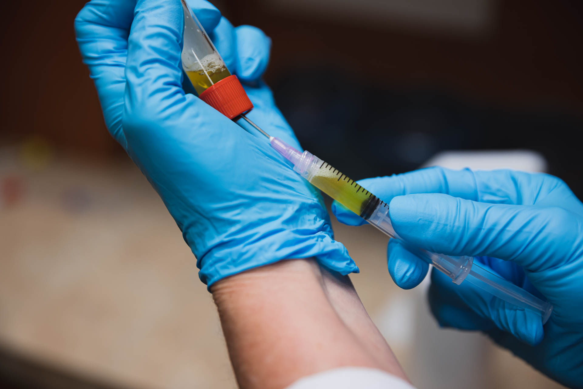 A provider uses a syringe to gather PRP, which they use for a balding treatment in Arlington.